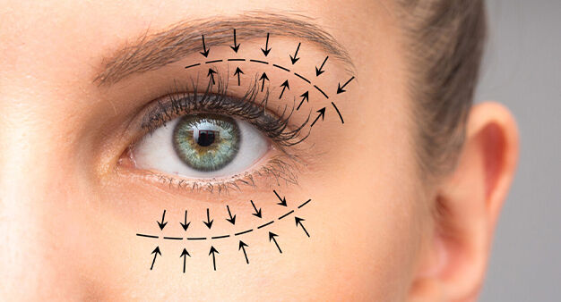 بلفاروپلاستی چیست؟