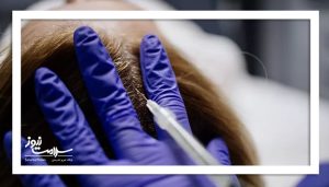 تزریق پلاسمای غنی از پلاکت (PRP) برای ریزش مو