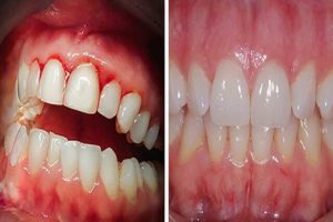 رژیم غذایی مدیترانه‌ای می‌تواند بیماری لثه را کاهش دهد