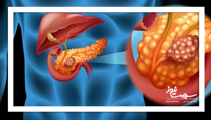 عادت ساده‌ای که نادیده گرفتنش خطر سرطان لوزالمعده را سه برابر میکند