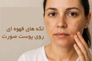 لکه های قهوه ای روی پوست صورت نشانه چیست؟