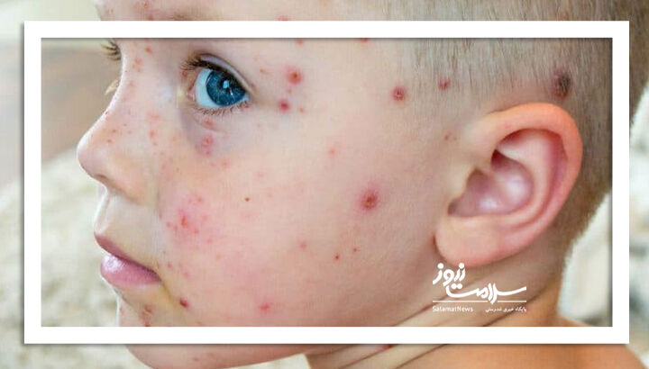 هشدار درباره آبله‌مرغان؛ عارضه‌ای خاموش که فراموش نمی‌شود!