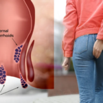 درمان قطعی بواسیر با لیزر؛ پایان دردهای همیشگی در بیماری های نشیمنگاهی