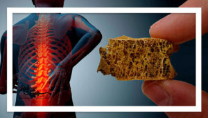 چگونه مانع پوک شدن استخوانها شویم؟