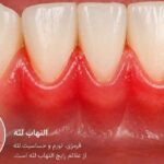 از التهاب لثه تا ازدست رفتن دندان؛ علائمی که نباید نادیده گرفته شوند