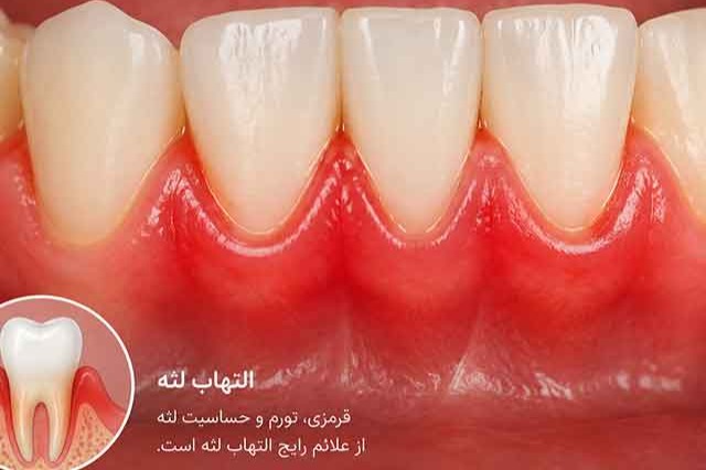 از التهاب لثه تا ازدست رفتن دندان؛ علائمی که نباید نادیده گرفته شوند